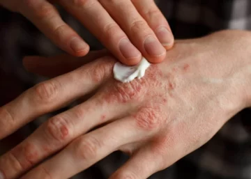 Día Mundial de la Psoriasis: Concientizar para romper mitos y acompañar a quienes la padecen