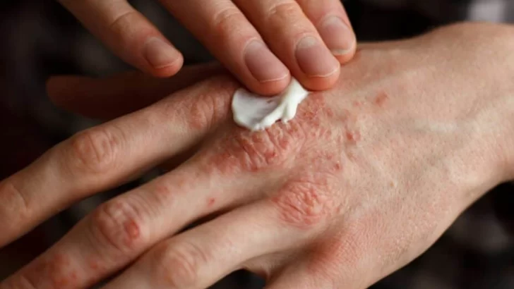 Día Mundial de la Psoriasis: Concientizar para romper mitos y acompañar a quienes la padecen