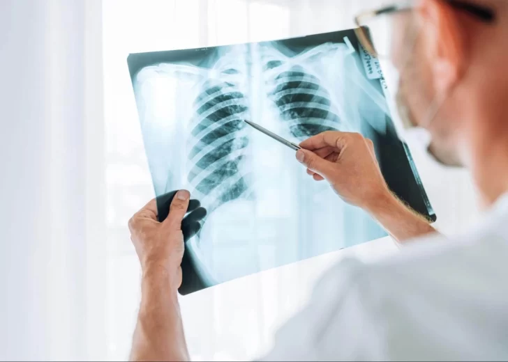 Día Mundial contra la Neumonía: Una enfermedad prevenible que aún causa millones de muertes Día Mundial contra la Neumonía: Una enfermedad prevenible que aún causa millones de muertes