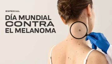 Día Mundial del Melanoma: La regla “ABCDE” que puede ayudar a detectarlo a tiempo Día Mundial del Melanoma: La regla “ABCDE” que puede ayudar a detectarlo a tiempo
